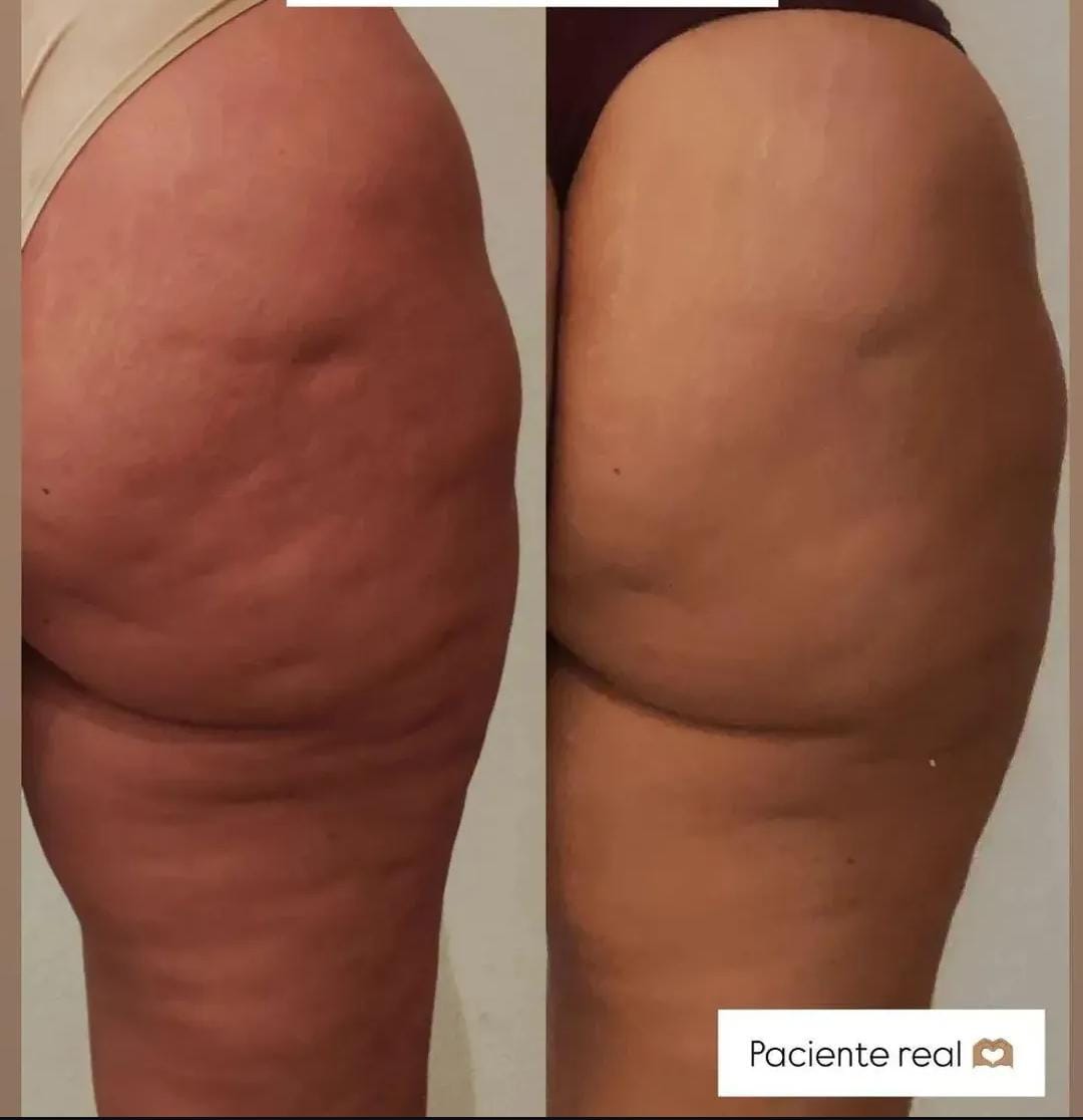 Tratamiento de Glúteos Antes y Después